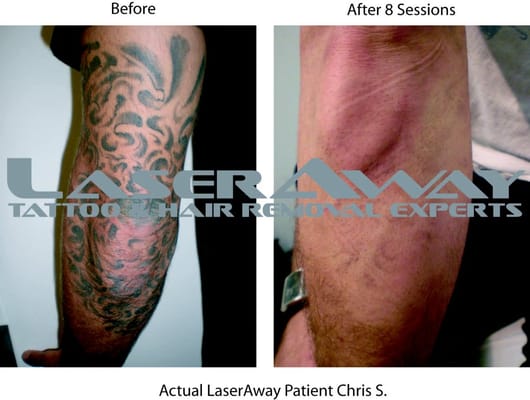 Painless Tattoo Removal San Diego Laser Tattoo Removal